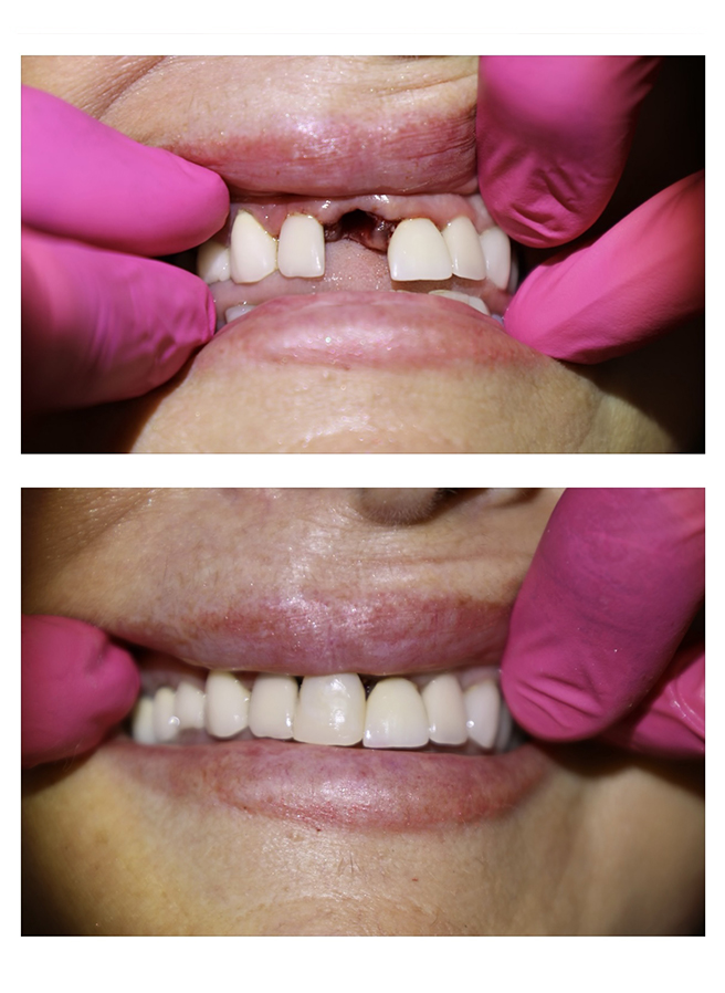 Before and after result 4